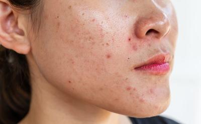 At-Home LED Therapy Effective Against Acne