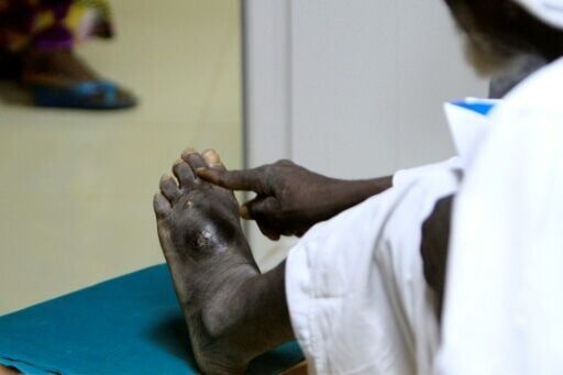 A patient shows his infected foot -- mycetoma is a progressively destructive infectious disease
